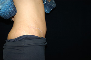 Abdominoplasty10