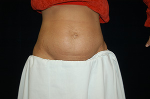 Abdominoplasty5
