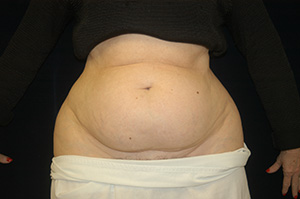 Abdominoplasty3a