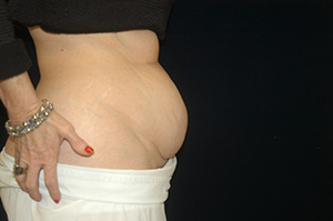 Abdominoplasty3c