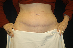 Abdominoplasty3b