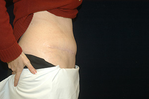 Abdominoplasty3d