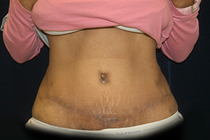Abdominoplasty 5b