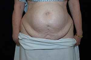 Abdominoplasty 6a