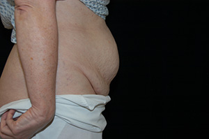 Abdominoplasty 6c