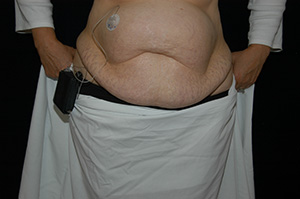 Abdominoplasty 4a