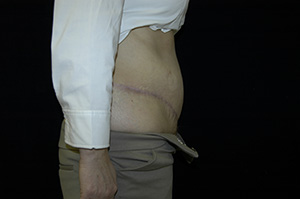 Abdominoplasty 4c