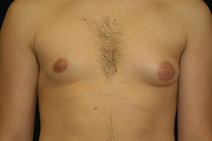 Gynecomastia 1a