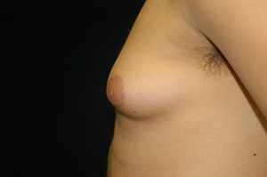 Gynecomastia 1b