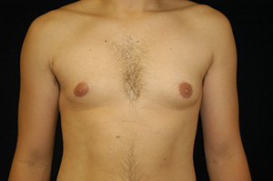 Gynecomastia 1c