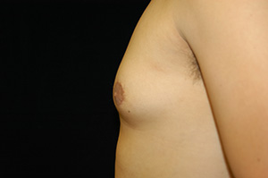 Gynecomastia 1d