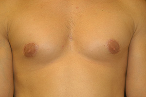 Gynecomastia 2b