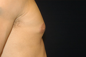 Gynecomastia 2d