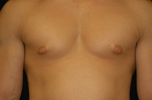 Gynecomastia 2a