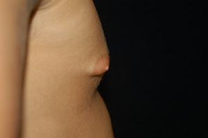 Gynecomastia 2c
