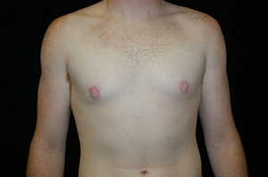 Gynecomastia 3b