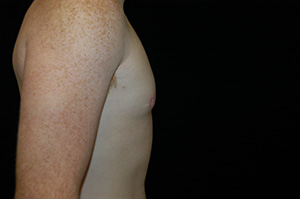 Gynecomastia 3d