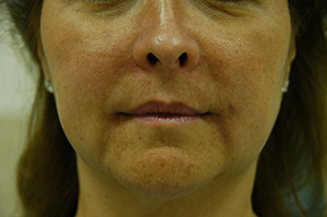 Juvederm 2b