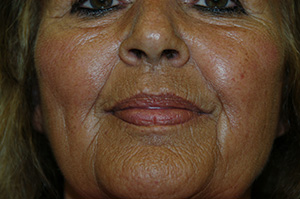 Juvederm 5a