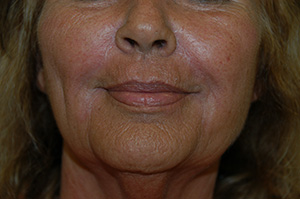 Juvederm 5b
