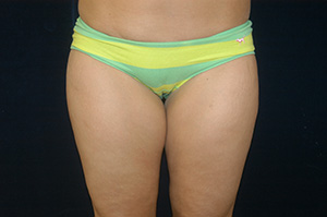 Liposuction 1a