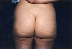 Liposuctions 4b