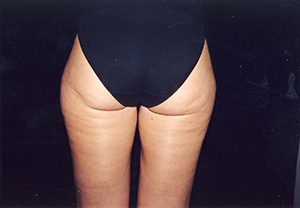 Liposuction 2a