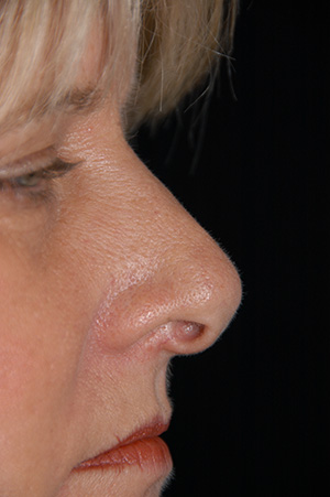 Rhinoplasty 1a